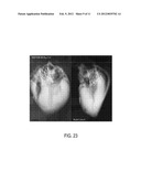 STENT FOR VALVE REPLACEMENT diagram and image