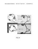 STENT FOR VALVE REPLACEMENT diagram and image