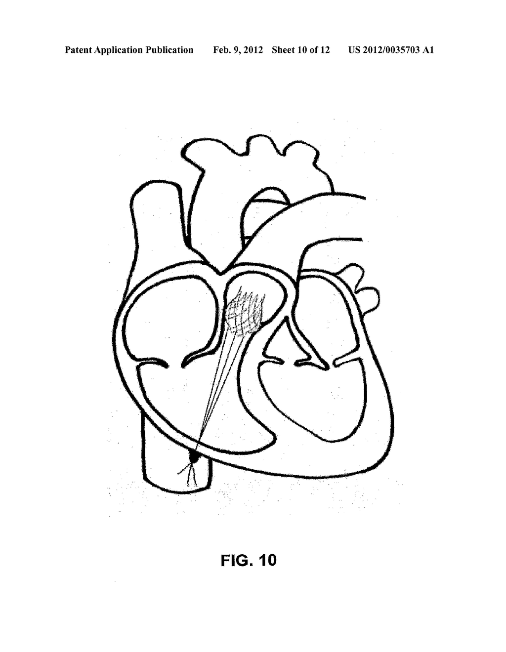 Truncated Conical Heart Valve Stent with Anchoring Threads and Methods of     Use - diagram, schematic, and image 11