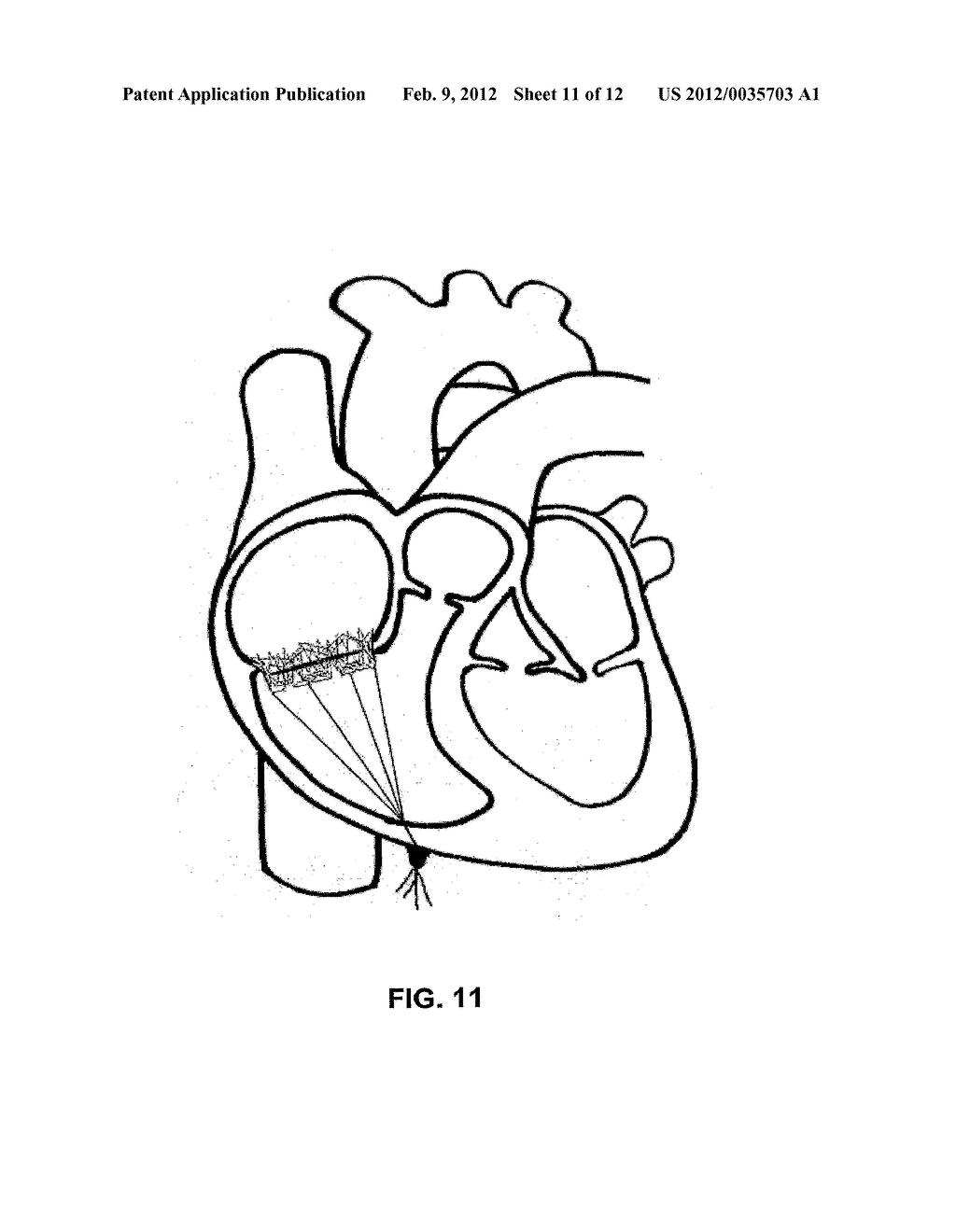 Truncated Conical Heart Valve Stent with Anchoring Threads and Methods of     Use - diagram, schematic, and image 12