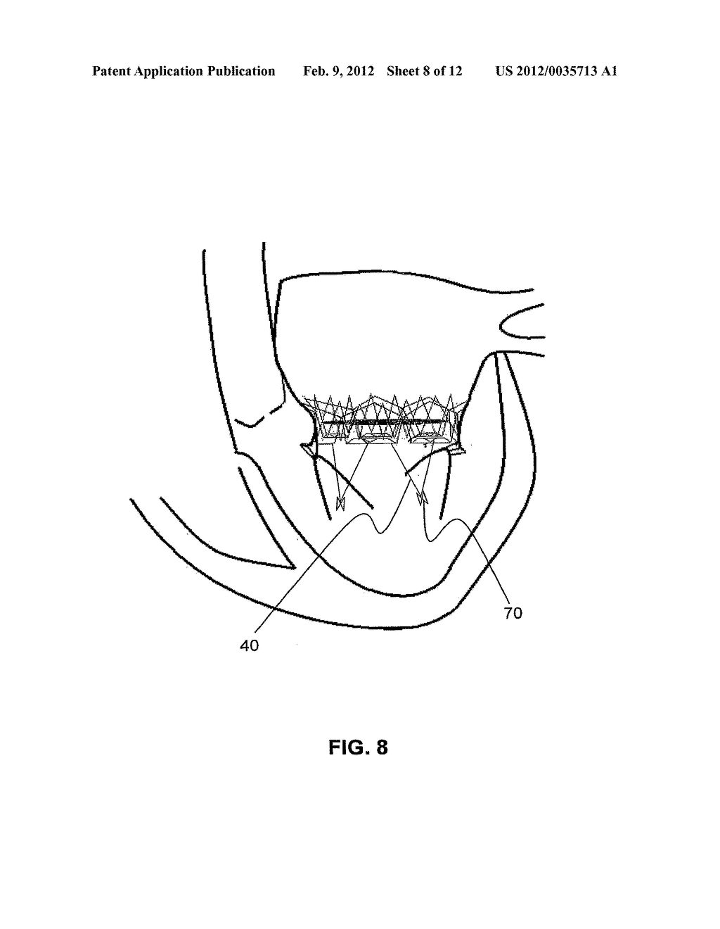 Truncated Cone Heart Valve Stent - diagram, schematic, and image 09