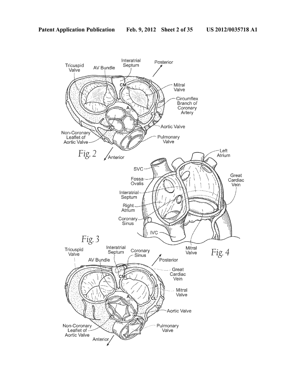 DEVICES, SYSTEMS, AND METHODS FOR RESHAPING A HEART VALVE ANNULUS - diagram, schematic, and image 03