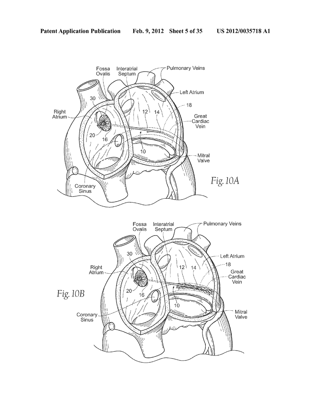 DEVICES, SYSTEMS, AND METHODS FOR RESHAPING A HEART VALVE ANNULUS - diagram, schematic, and image 06