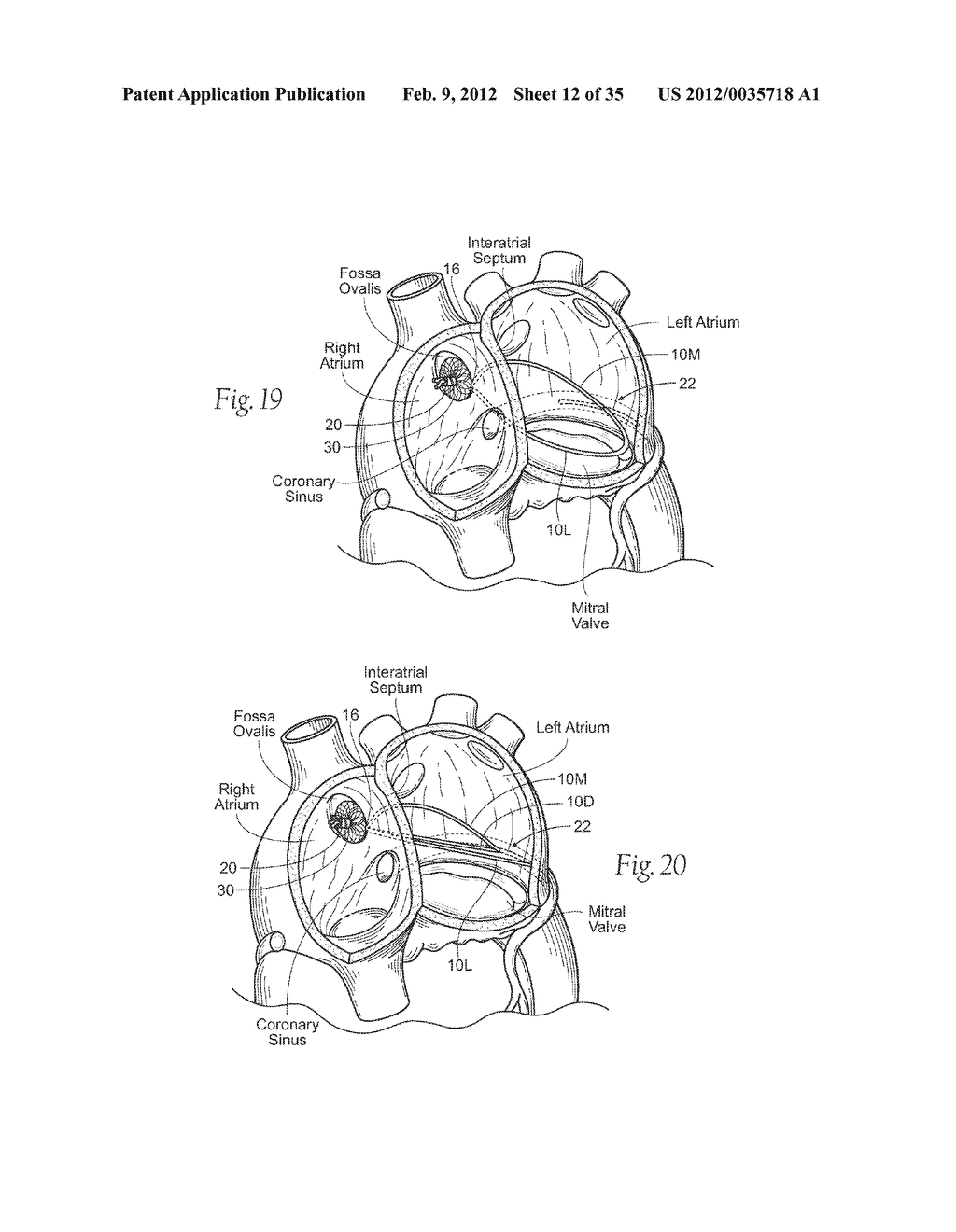 DEVICES, SYSTEMS, AND METHODS FOR RESHAPING A HEART VALVE ANNULUS - diagram, schematic, and image 13