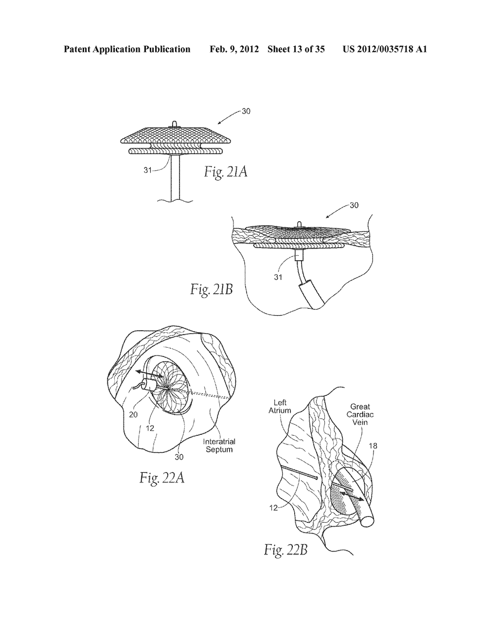 DEVICES, SYSTEMS, AND METHODS FOR RESHAPING A HEART VALVE ANNULUS - diagram, schematic, and image 14