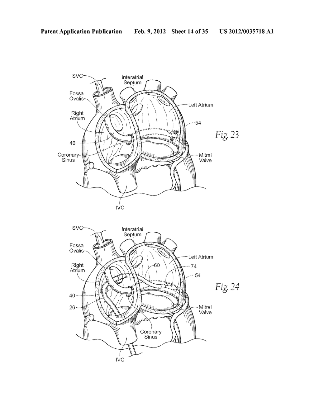 DEVICES, SYSTEMS, AND METHODS FOR RESHAPING A HEART VALVE ANNULUS - diagram, schematic, and image 15