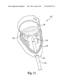 Mitral Prosthesis and Methods for Implantation diagram and image