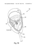 Mitral Prosthesis and Methods for Implantation diagram and image