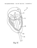 Mitral Prosthesis and Methods for Implantation diagram and image