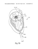 Mitral Prosthesis and Methods for Implantation diagram and image