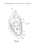 Mitral Prosthesis and Methods for Implantation diagram and image