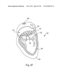 Mitral Prosthesis and Methods for Implantation diagram and image