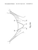 Mitral Prosthesis and Methods for Implantation diagram and image