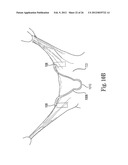 Mitral Prosthesis and Methods for Implantation diagram and image