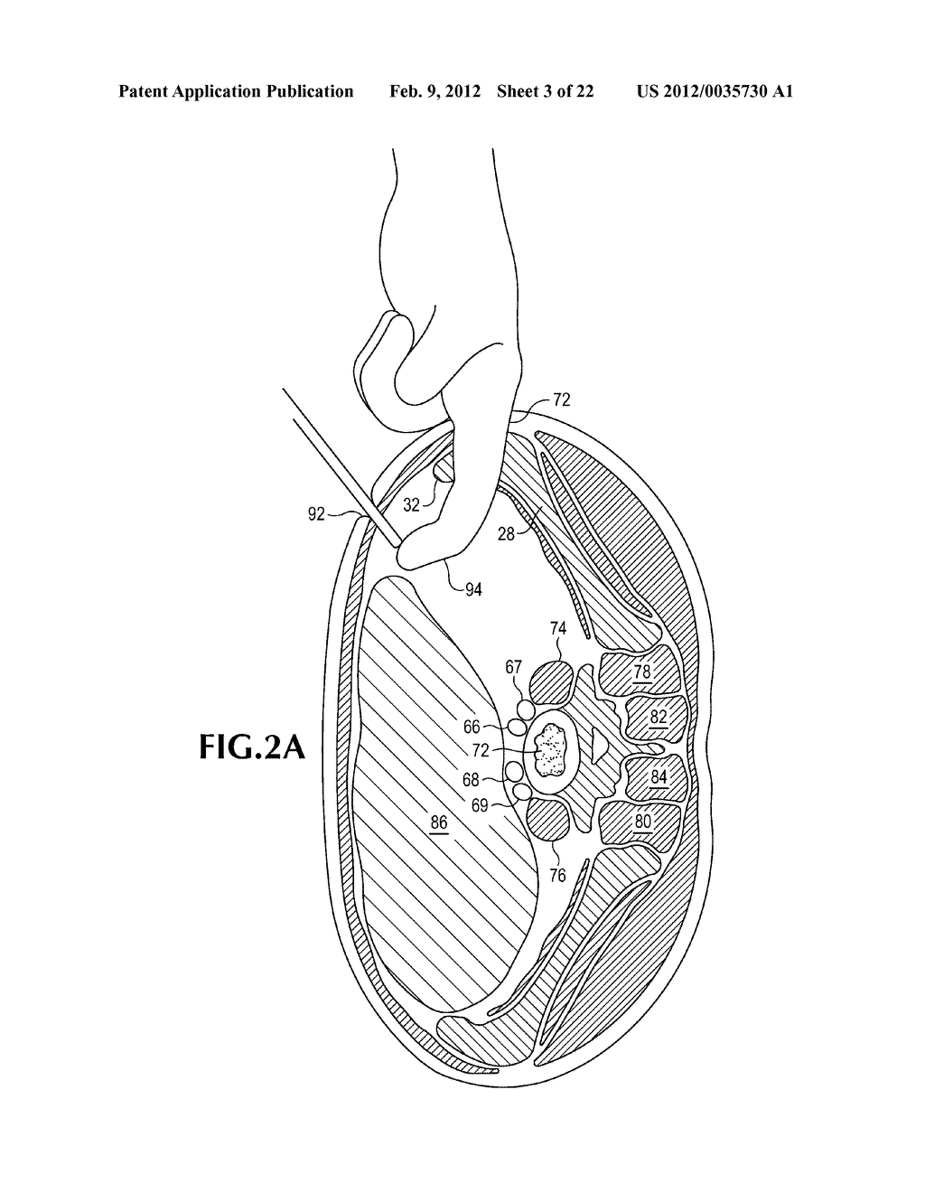 MINIMALLY-INVASIVE RETROPERITONEAL LATERAL APPROACH FOR SPINAL SURGERY - diagram, schematic, and image 04