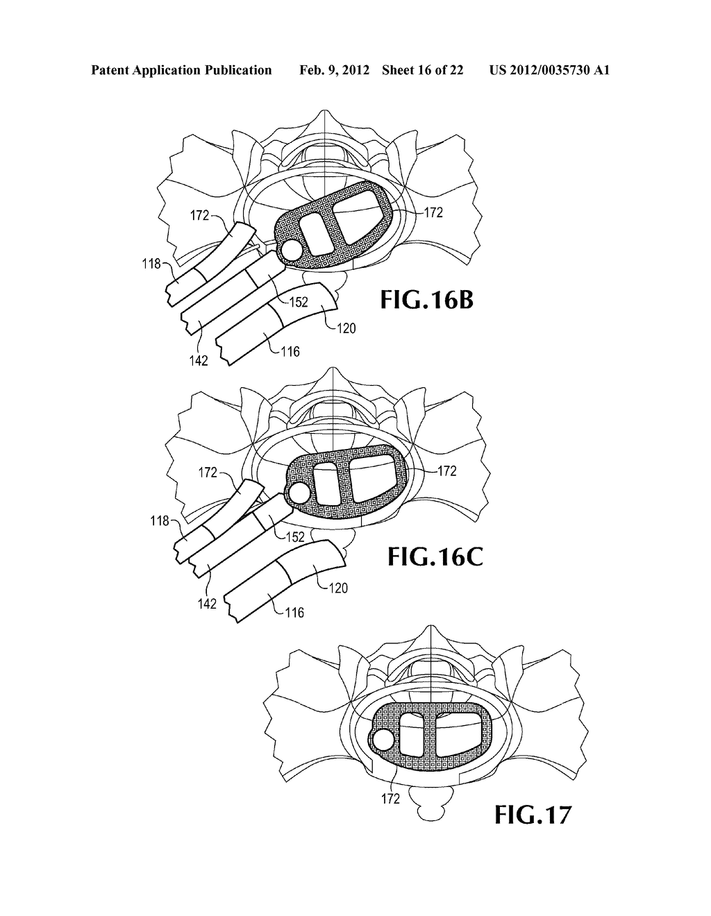 MINIMALLY-INVASIVE RETROPERITONEAL LATERAL APPROACH FOR SPINAL SURGERY - diagram, schematic, and image 17