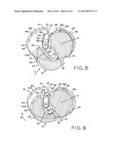 TIBIAL PROSTHESIS diagram and image