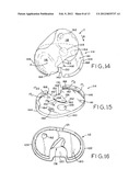 TIBIAL PROSTHESIS diagram and image