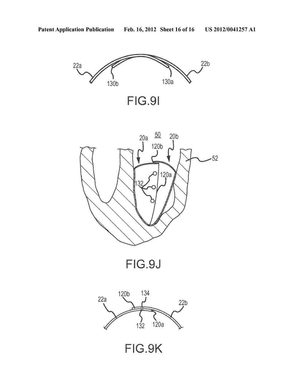 APPARATUS AND METHODS FOR SUPPORTING CARDIAC ISCHEMIC TISSUE - diagram, schematic, and image 17