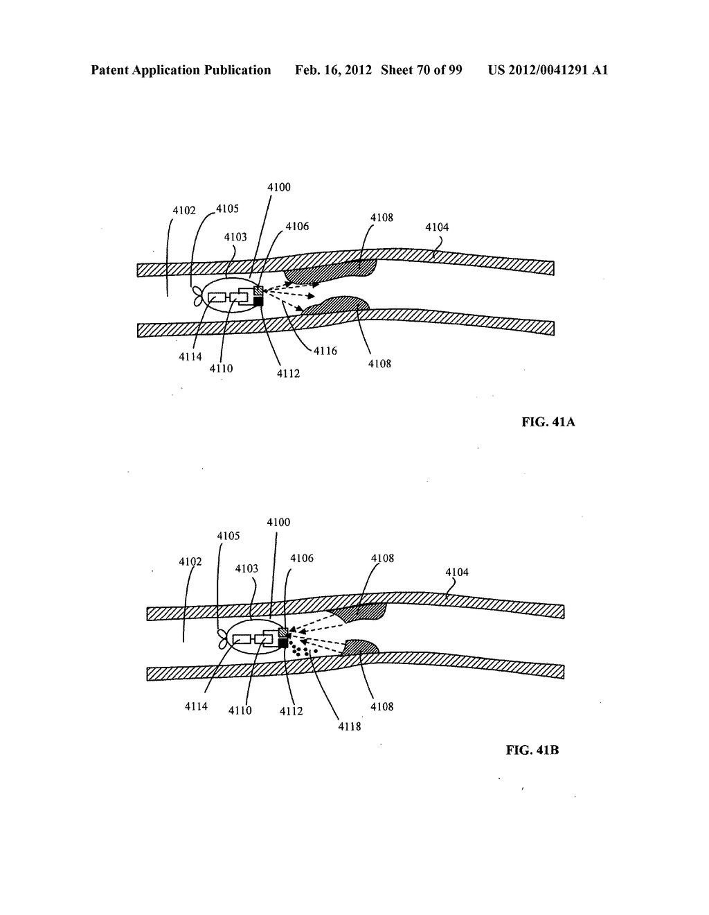 Temporal control of a lumen traveling device in a body tube tree - diagram, schematic, and image 71