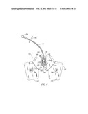 CATHETER ANCHORING SYSTEM diagram and image