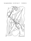CABLE TIE SYSTEM FOR STABILIZING BONE diagram and image