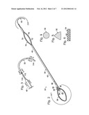 CABLE TIE SYSTEM FOR STABILIZING BONE diagram and image