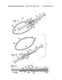 CABLE TIE SYSTEM FOR STABILIZING BONE diagram and image