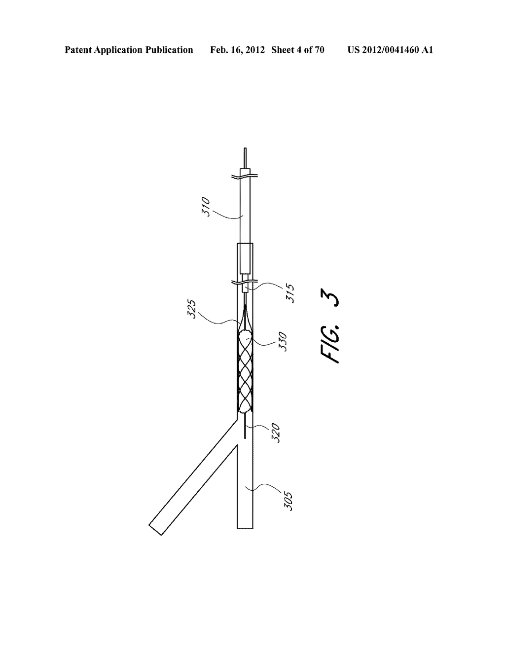 THROMBUS MANAGEMENT SYSTEM - diagram, schematic, and image 05