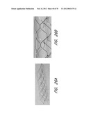 THROMBUS MANAGEMENT DEVICE diagram and image