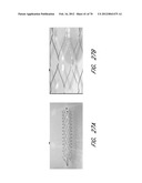 THROMBUS MANAGEMENT DEVICE diagram and image