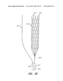 THROMBUS MANAGEMENT DEVICE diagram and image