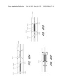 THROMBUS MANAGEMENT DEVICE diagram and image