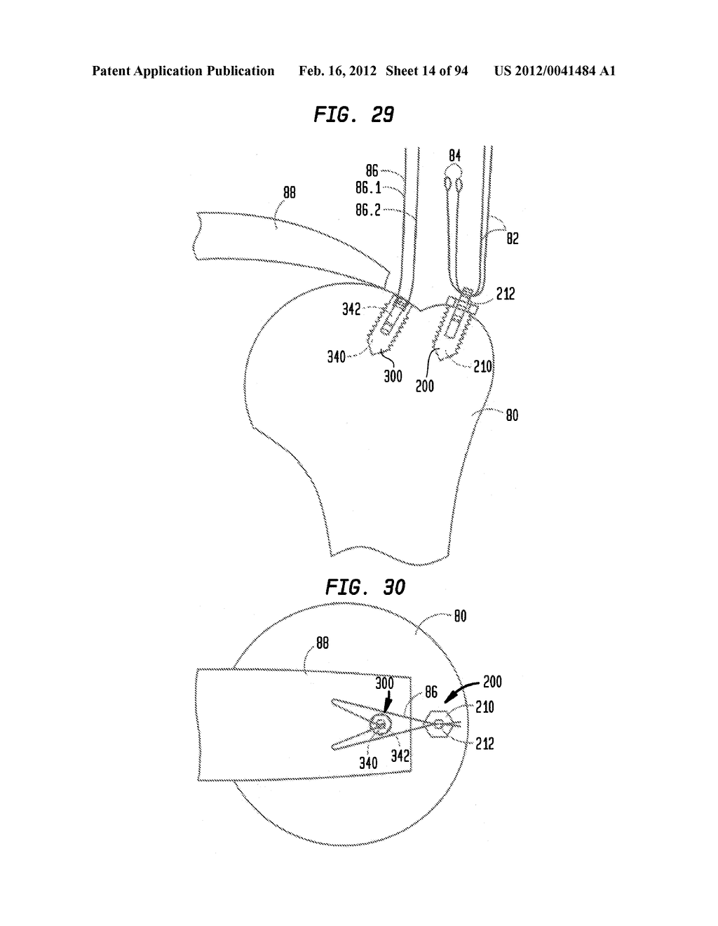 MEDICAL DEVICE AND PROCEDURE FOR ATTACHING TISSUE TO BONE - diagram, schematic, and image 15