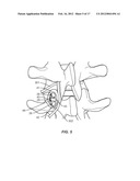 VERTEBRAL IMPLANT diagram and image