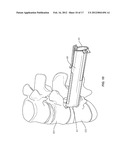 VERTEBRAL IMPLANT diagram and image