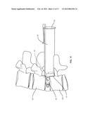 VERTEBRAL IMPLANT diagram and image