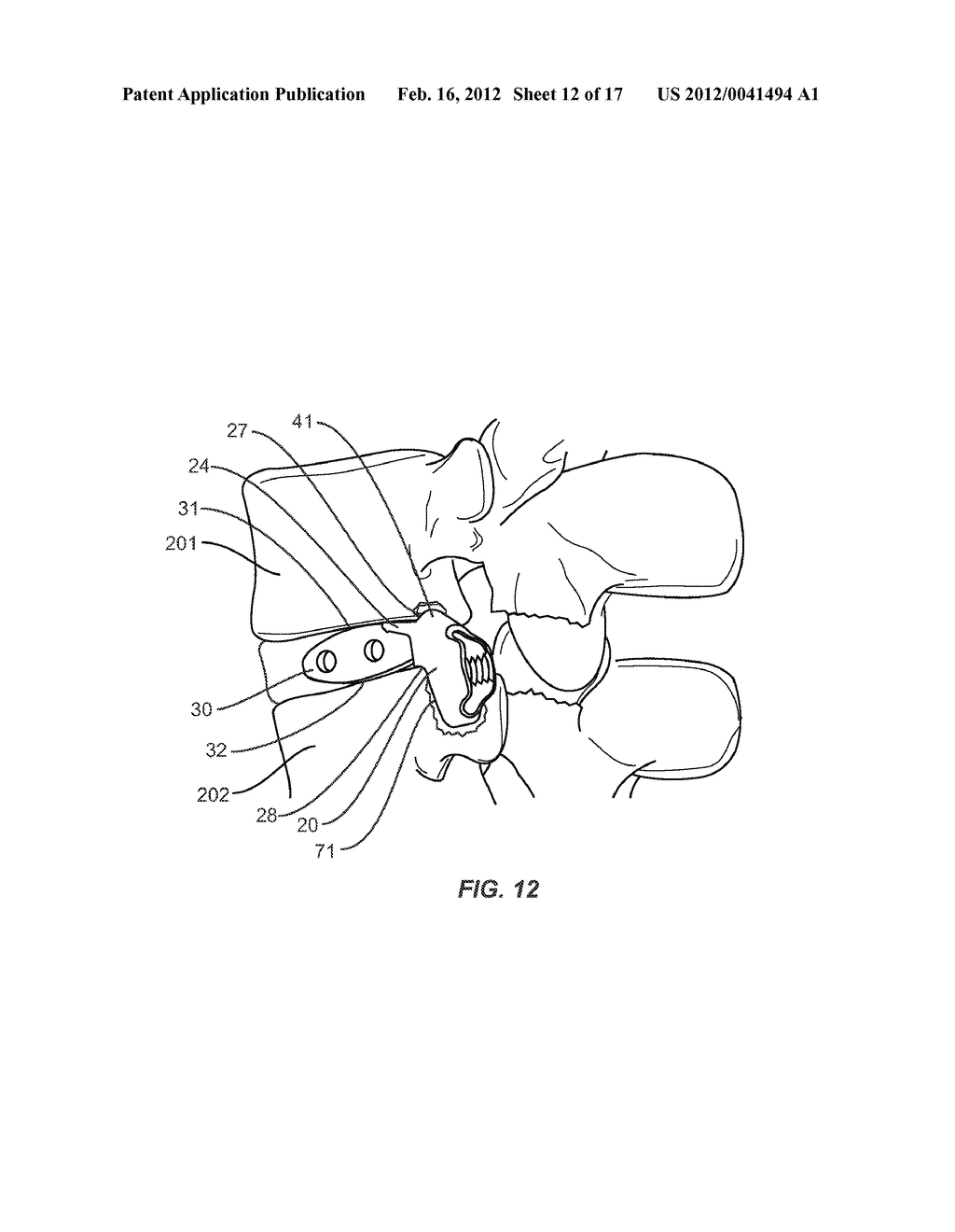 VERTEBRAL IMPLANT - diagram, schematic, and image 13