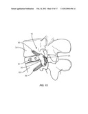 VERTEBRAL IMPLANT diagram and image