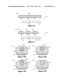 COCHLEAR IMPLANT WITH IMPROVED LUMEN ARRANGEMENT diagram and image