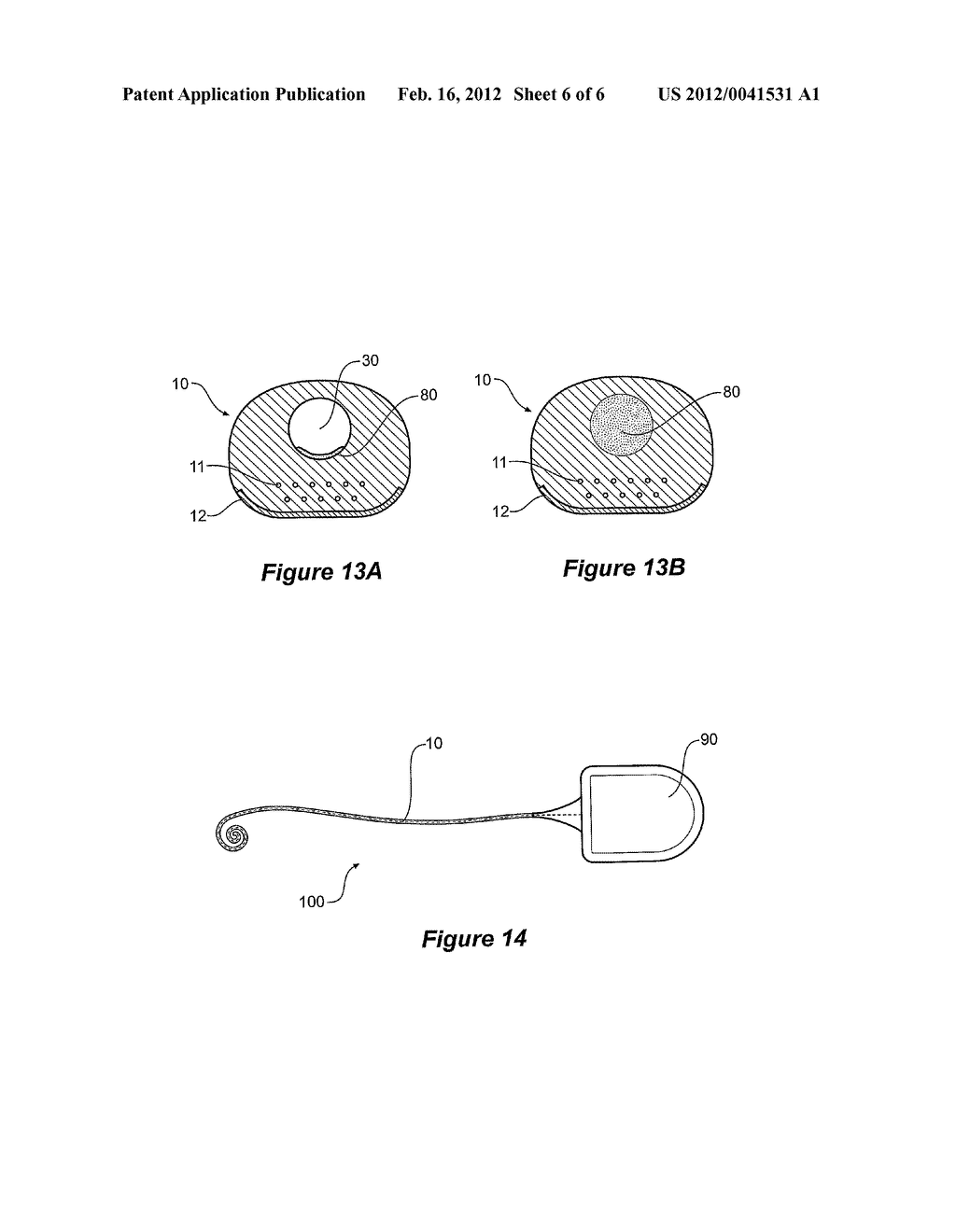 COCHLEAR IMPLANT WITH IMPROVED LUMEN ARRANGEMENT - diagram, schematic, and image 07