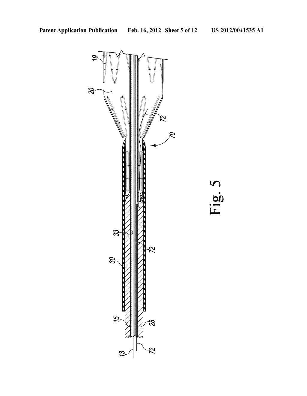 PRECANNULATED FENESTRATION - diagram, schematic, and image 06