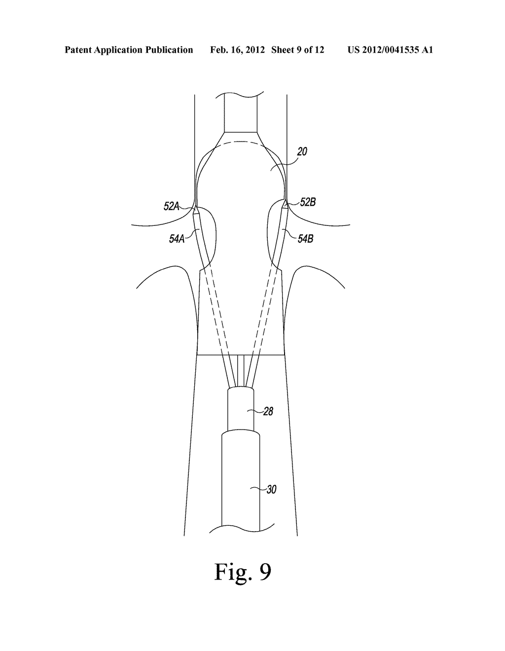 PRECANNULATED FENESTRATION - diagram, schematic, and image 10