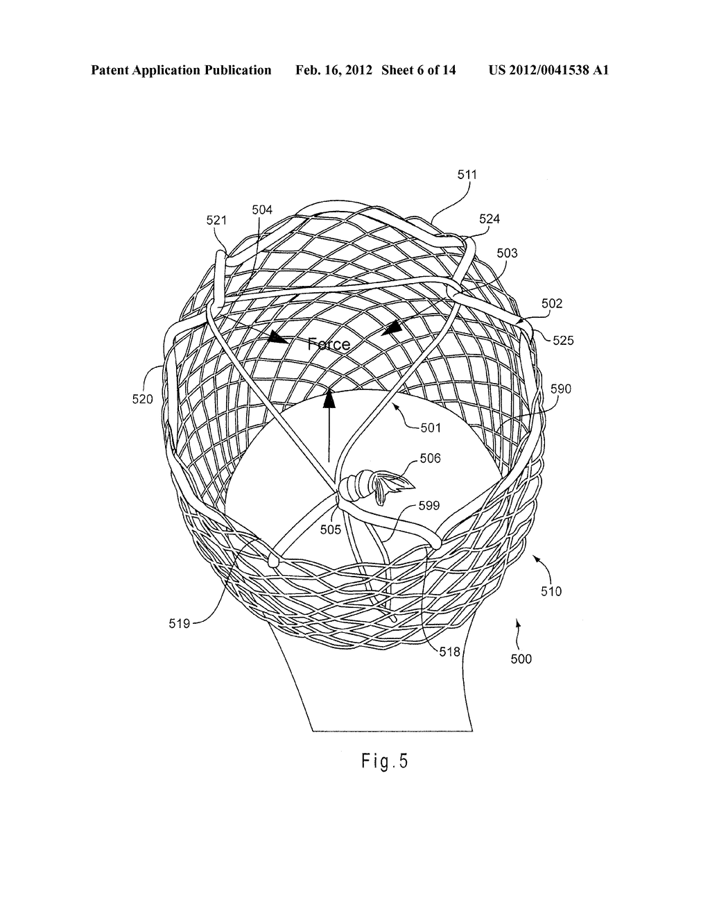 COLLAPSING STRUCTURE FOR REDUCING THE DIAMETER OF A STENT END - diagram, schematic, and image 07