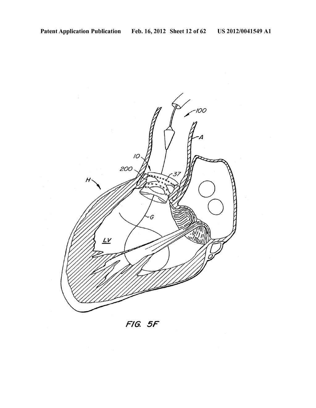 REPOSITIONABLE HEART VALVE AND METHOD - diagram, schematic, and image 13