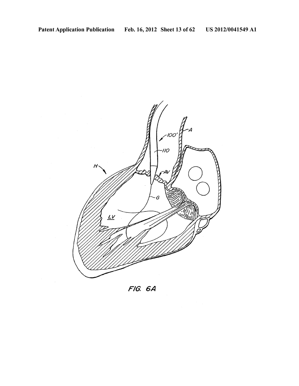 REPOSITIONABLE HEART VALVE AND METHOD - diagram, schematic, and image 14