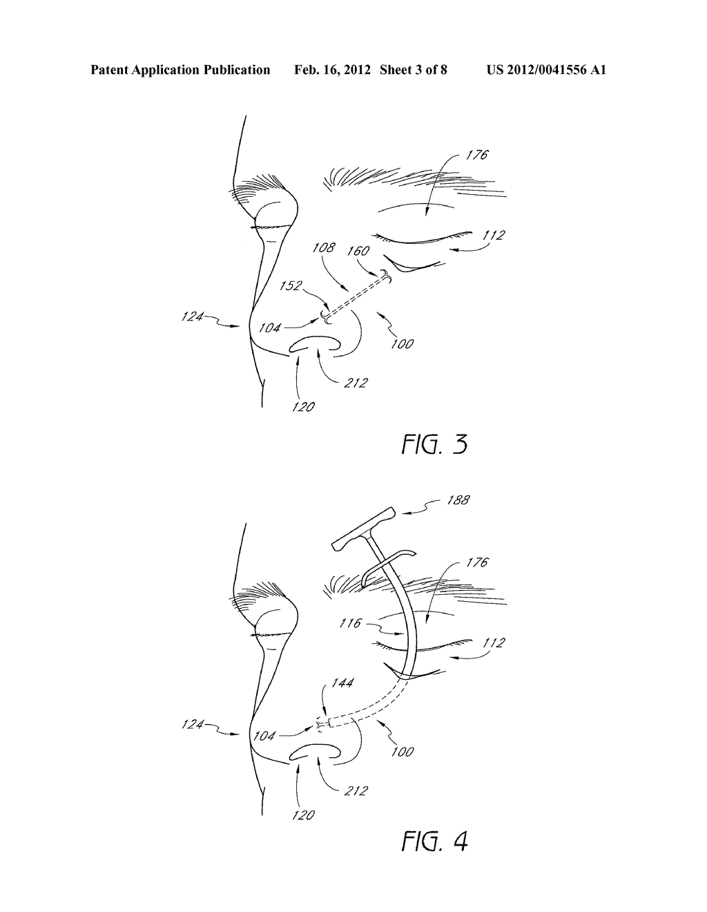 METHODS AND DEVICES FOR RHINOPLASTY AND TREATING INTERNAL VALVE STENOSIS - diagram, schematic, and image 04