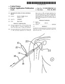 Resurfacing implant for a humeral head diagram and image