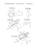 Resurfacing implant for a humeral head diagram and image