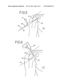 Resurfacing implant for a humeral head diagram and image